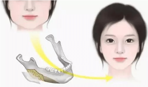下頜角切除通常是多少錢?它有什么優(yōu)勢呢?