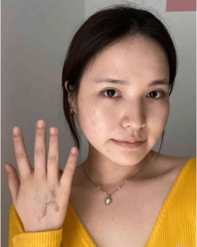 成都軍建醫(yī)院疤痕科怎么樣？附祛疤真人案例一覽