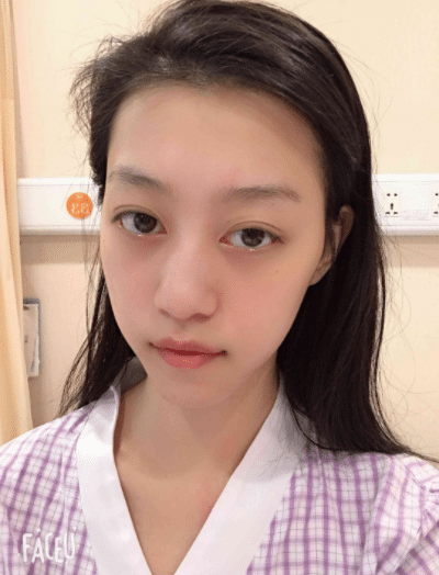 杭州連天美醫(yī)療美容醫(yī)院怎么樣？隆鼻前后效果一覽