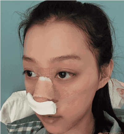 杭州連天美醫(yī)療美容醫(yī)院怎么樣？隆鼻前后效果一覽