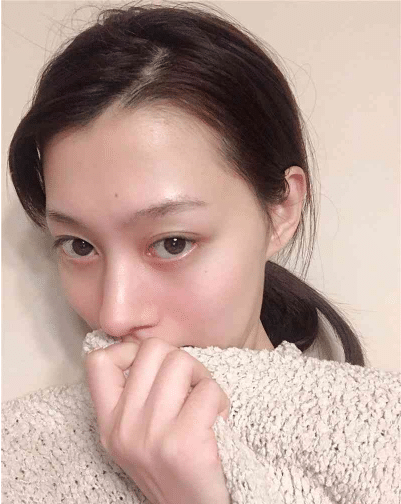 杭州連天美醫(yī)療美容醫(yī)院怎么樣？隆鼻前后效果一覽