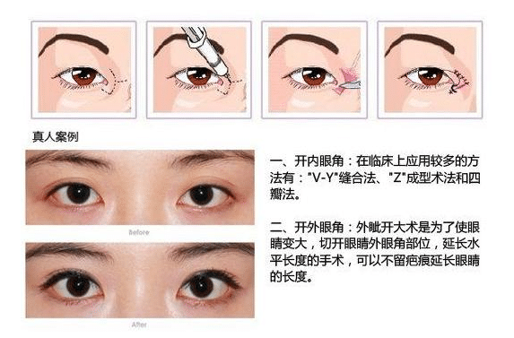 開眼角