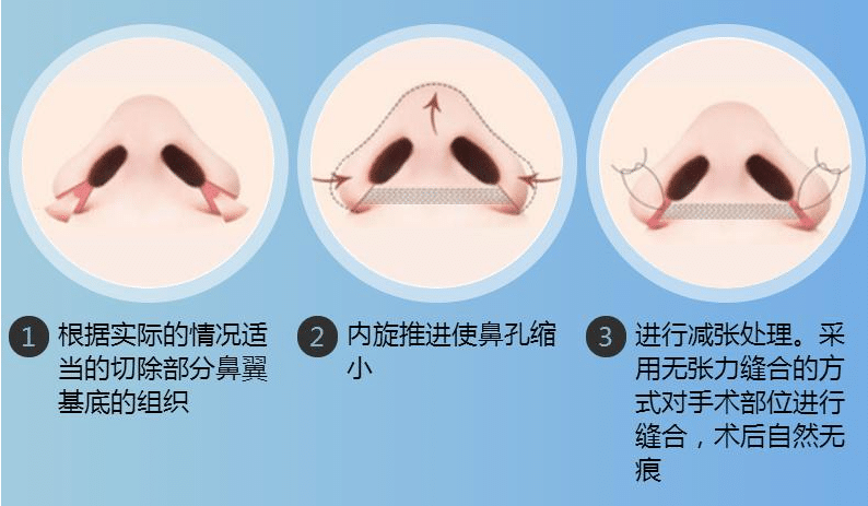 鼻翼縮小