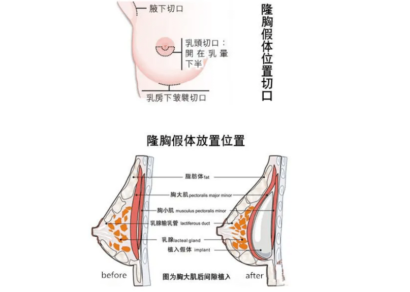 隆胸手術(shù)一般多少錢?隆胸很貴嗎?