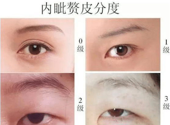 雙眼皮是埋線好還是全切好?手術(shù)維持時(shí)間的對(duì)比!