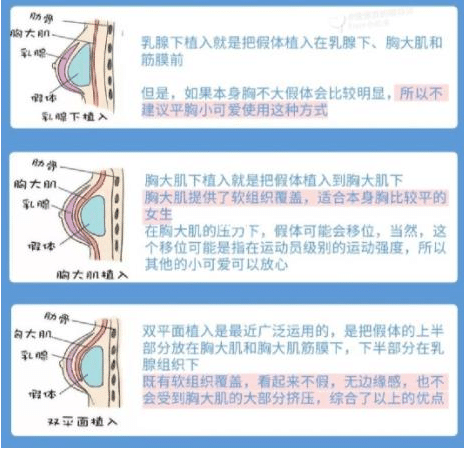 硅膠假體隆胸的注意事項有哪些？隆胸前的準(zhǔn)備匯總盤點