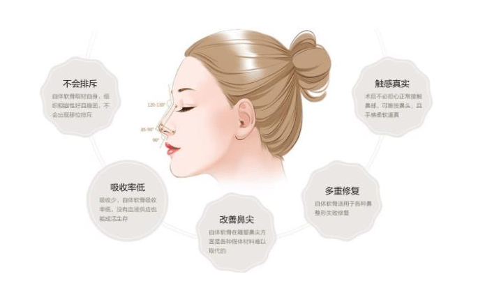 自體軟骨隆鼻的費(fèi)用是多少?自體軟骨隆鼻有哪些種類(lèi)?