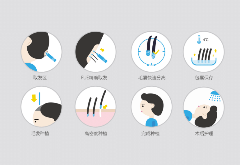 毛發(fā)移植