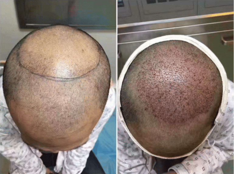 毛發(fā)移植