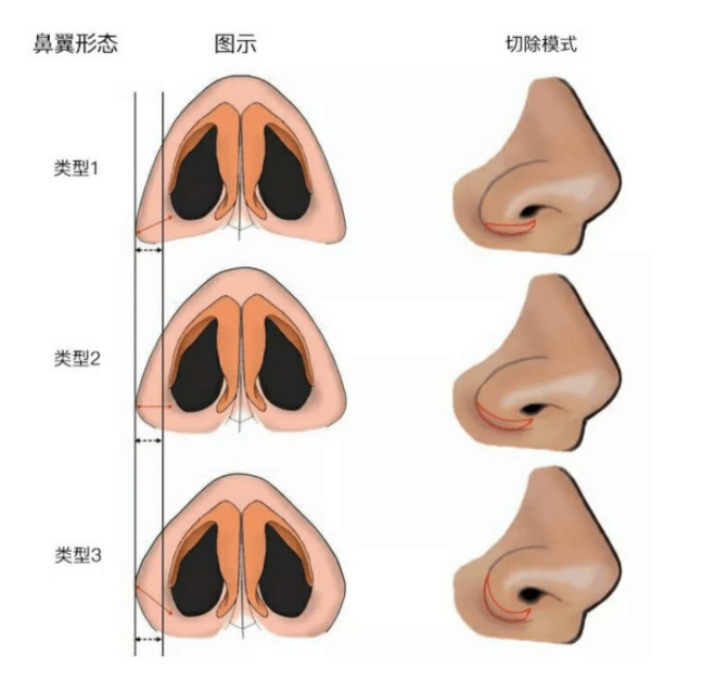 鼻翼縮小