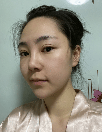 南京康美整形醫(yī)院靠譜不！馮思陽(yáng)隆鼻案例效果及價(jià)格一覽！