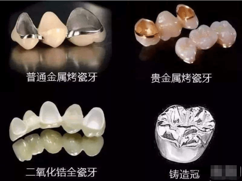 烤瓷牙多少錢一顆 烤瓷牙多少錢一顆