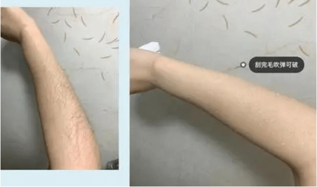脫毛 脫毛