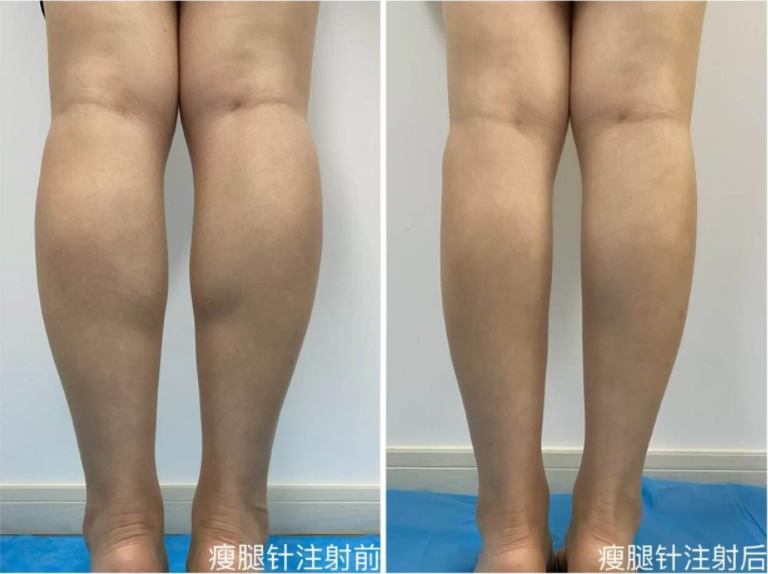 注射瘦腿針有副作用嗎，會反彈嗎?