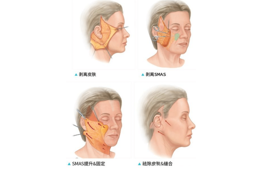 全國(guó)哪家整形醫(yī)院拉皮手術(shù)做的好？