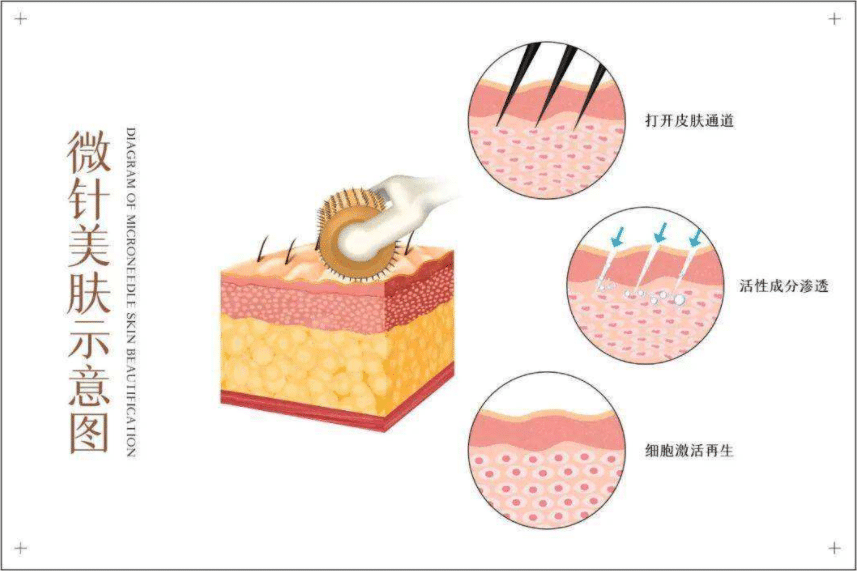 微針做一次的價(jià)格是多少? 微針做一次的價(jià)格是多少?