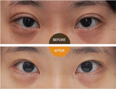 雙眼皮修復(fù)多少錢 雙眼皮修復(fù)多少錢