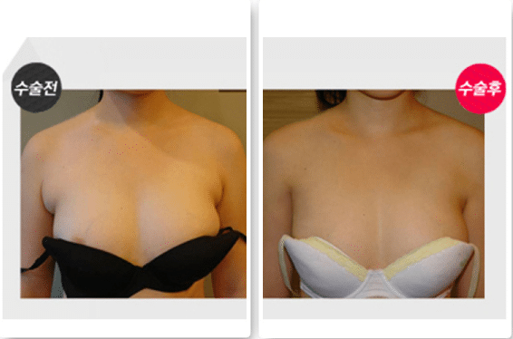 副乳切除手術 副乳切除手術