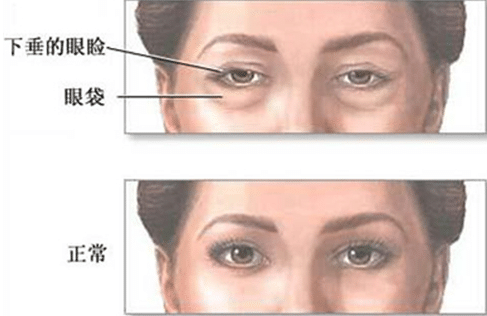 抽脂去眼袋效果怎么樣？恢復(fù)時(shí)間好久？能維持幾年？