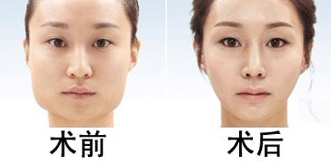 磨骨手術(shù)前后對比