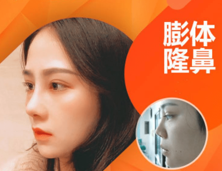 膨體隆鼻 膨體隆鼻