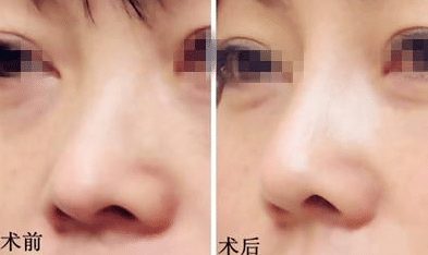膨體隆鼻前后對(duì)比 膨體隆鼻前后對(duì)比
