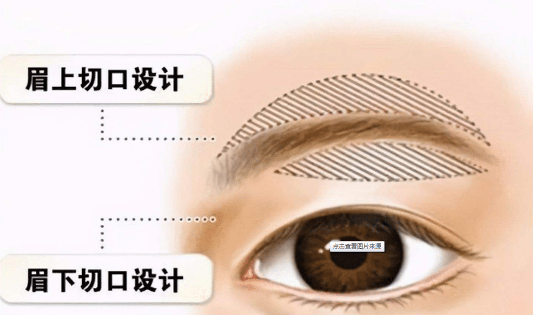 提眉手術(shù)的價(jià)格是多少？效果怎么樣？