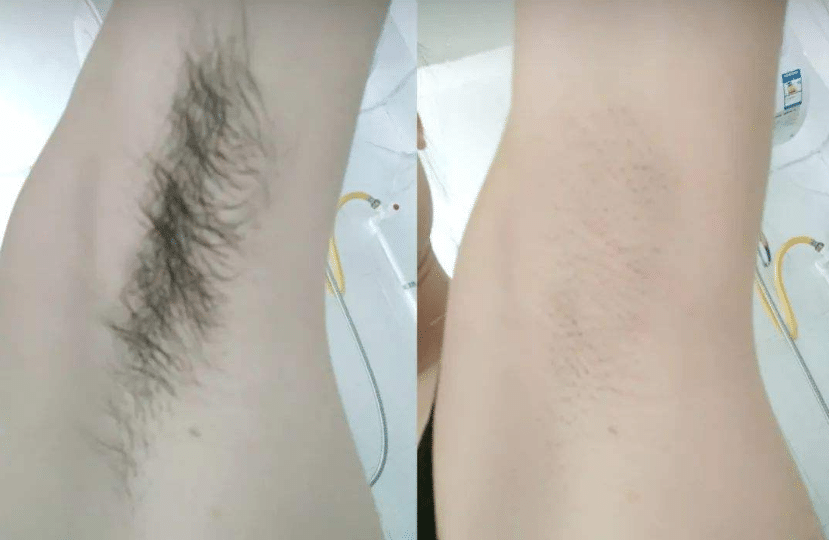 永久性脫毛前后對比 永久性脫毛前后對比