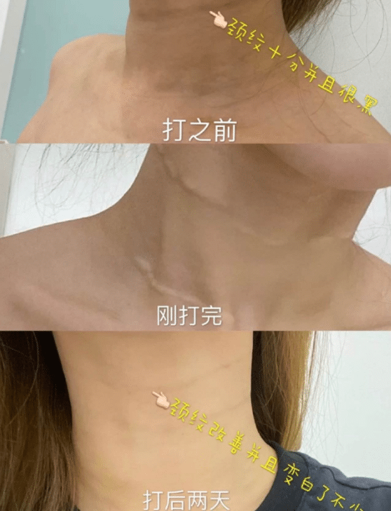 去頸紋前后對比 去頸紋前后對比