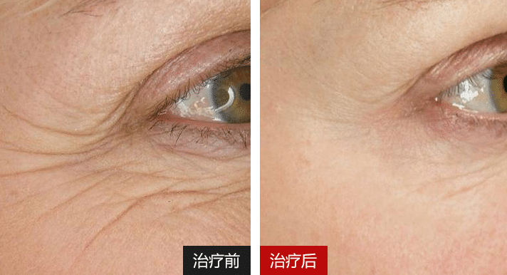 眼周抗衰前后對比 眼周抗衰前后對比