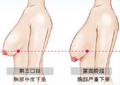 胸部 胸部