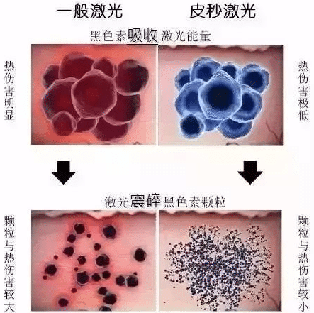 黃褐斑可以祛除嗎？怎么才能徹底祛除？