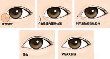 開眼角失敗多久能重新做呢？可以開第2次嗎？