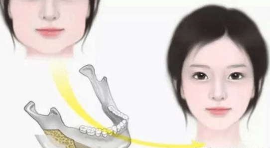 磨下頜角前后對(duì)比 磨下頜角前后對(duì)比