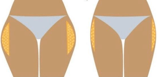 大腿外側(cè)抽脂前后對比 大腿外側(cè)抽脂前后對比