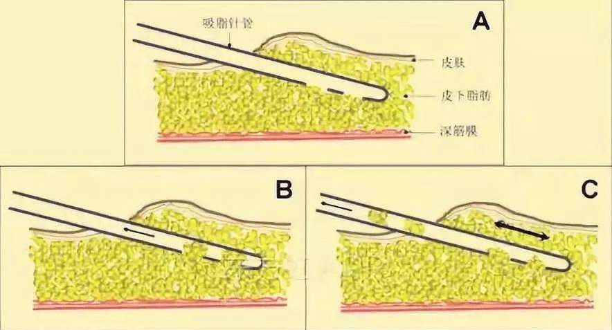 大腿抽脂 大腿抽脂