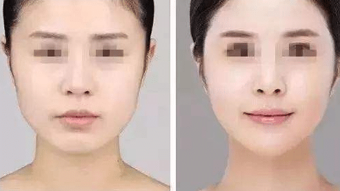 注射咬肌前后對(duì)比 注射咬肌前后對(duì)比