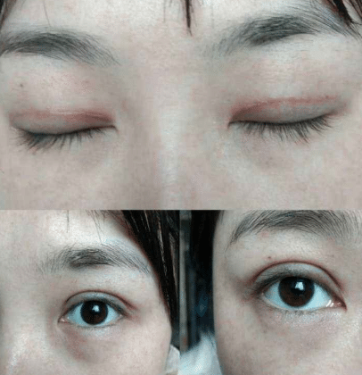 全切雙眼皮肉條和腫的區(qū)別