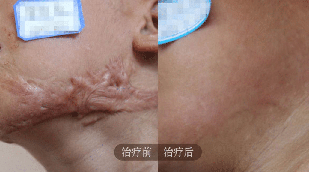 疤痕修復(fù) 疤痕修復(fù)