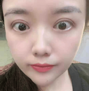 雙眼皮 雙眼皮