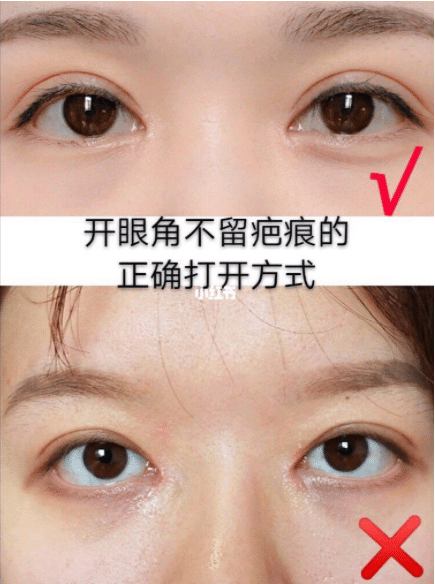 開眼角拆線后洗臉需要注意什么，開眼角術(shù)后怎么護理?