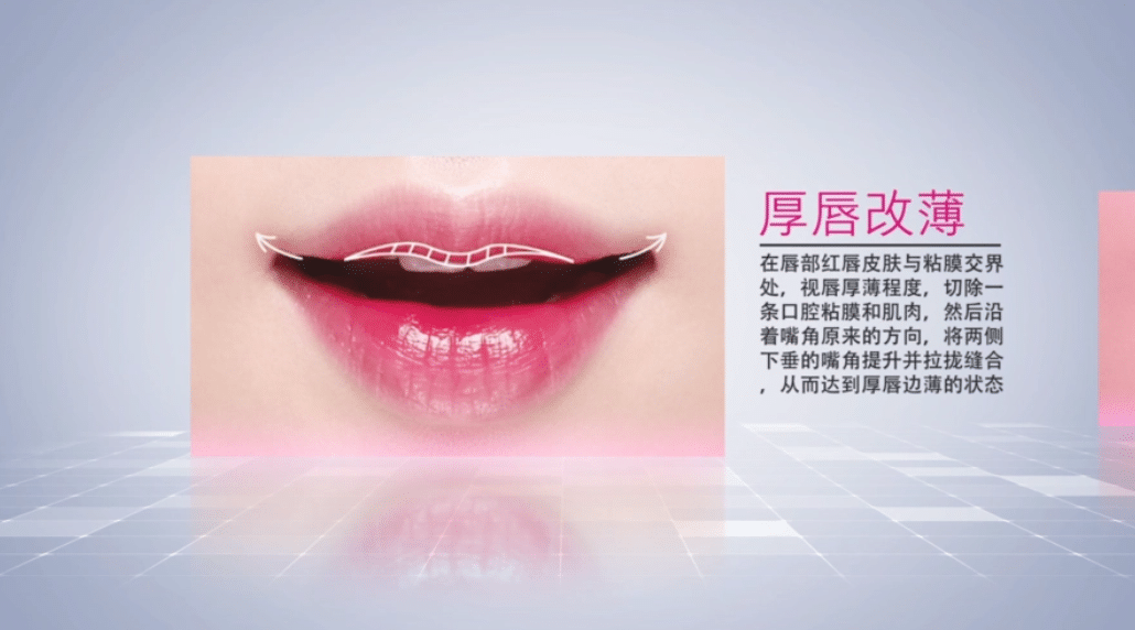 厚唇改薄 厚唇改薄