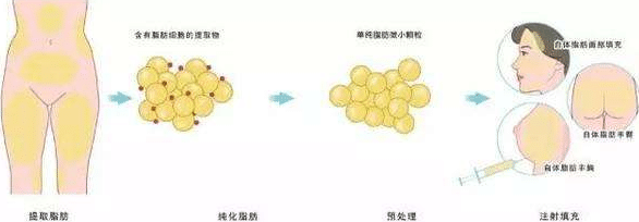 抽脂隆胸 抽脂隆胸