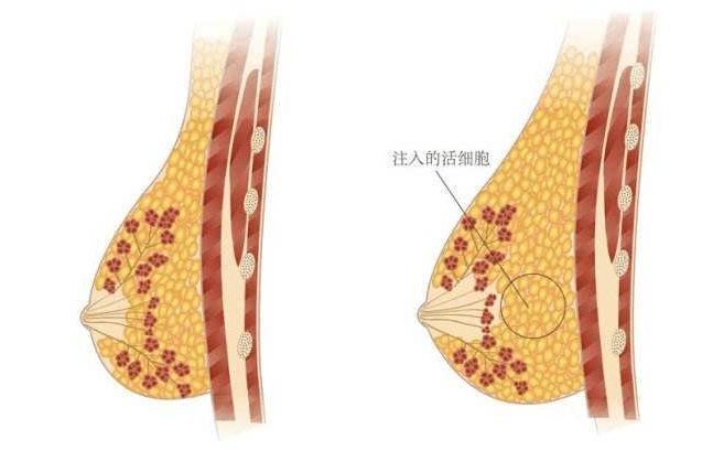 抽脂隆胸 抽脂隆胸