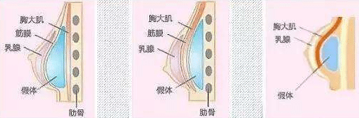 硅膠隆胸 硅膠隆胸