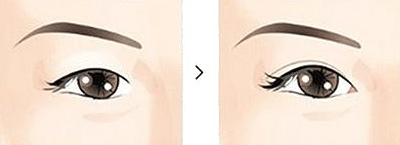 開眼角 開眼角