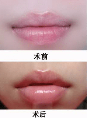 自體脂肪豐唇 自體脂肪豐唇
