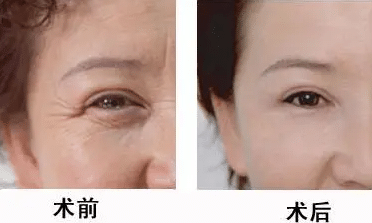 生物注射除皺 生物注射除皺