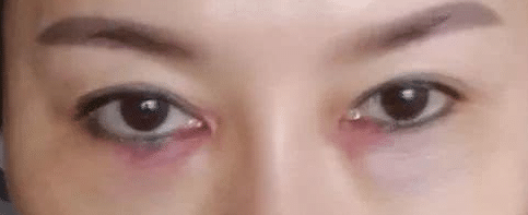 注射淚溝