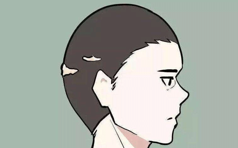 什么是疤痕植發(fā)？術(shù)后需要注意什么？